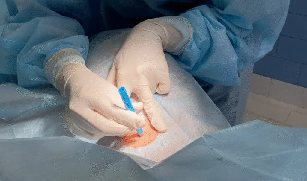 Mãos em procedimento cirúrgico com caneta