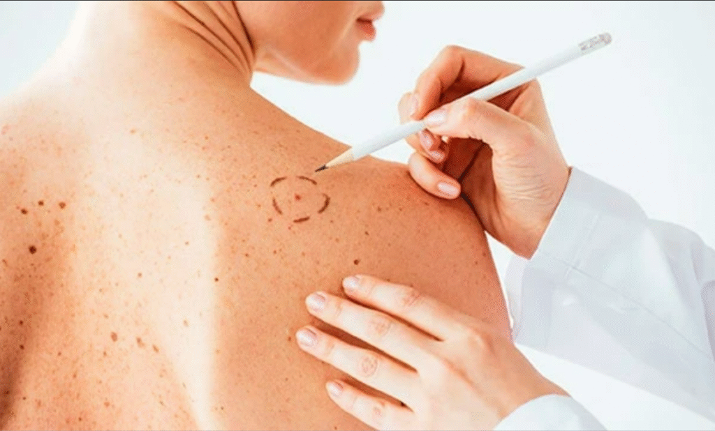 cirurgia-dermatologica-copacabana 7 Marcação de manchas na pele